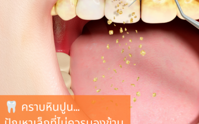 🦷 คราบหินปูน…ปัญหาเล็กที่ไม่ควรมองข้าม