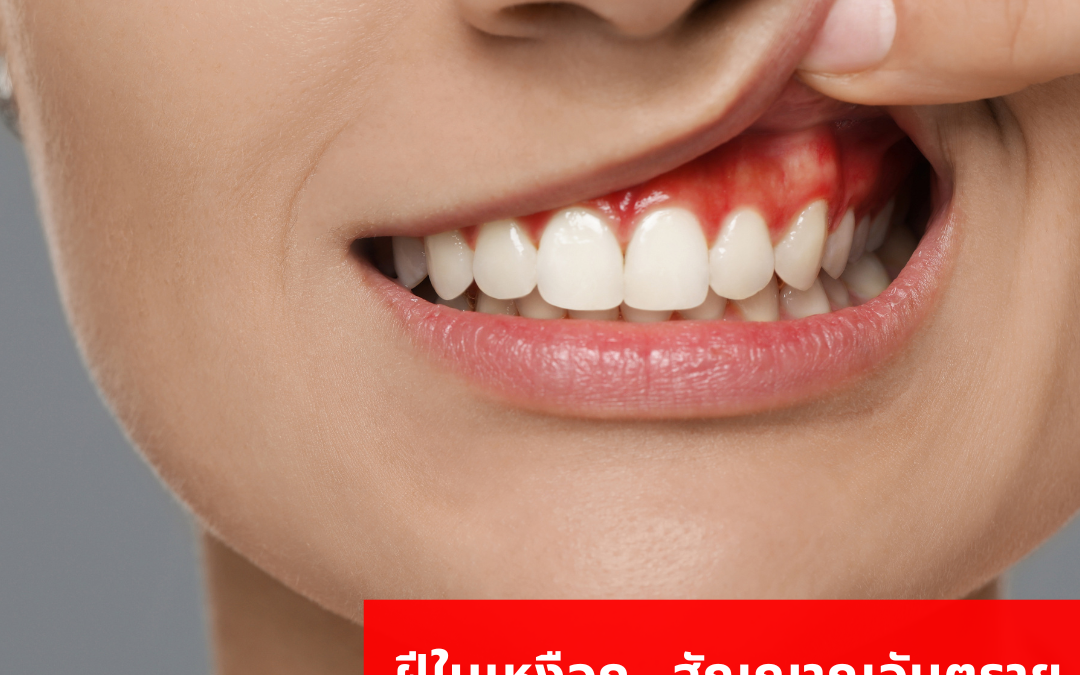 🦷 ฝีในเหงือก… สัญญาณอันตรายที่ไม่ควรมองข้าม! ⚠️